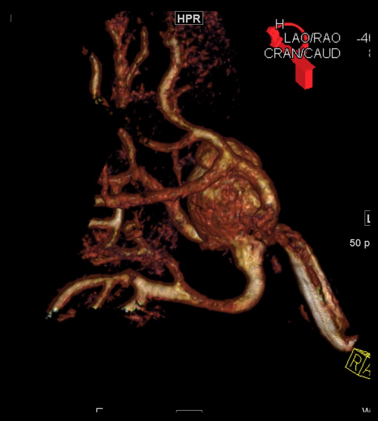 Renal aneurysm - 3D reformat