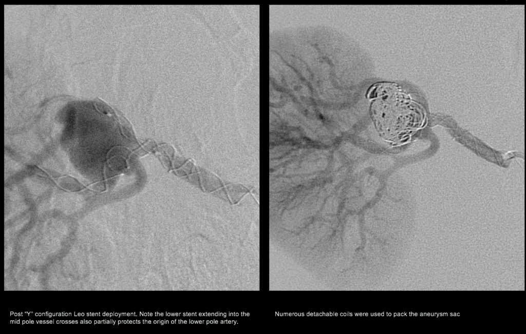 Renal aneurysm - stent assisted coiling (stents protect the normal artery branches)