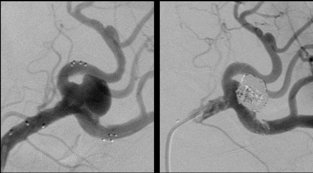 Splenic aneurysm - stent protected coiling to secure